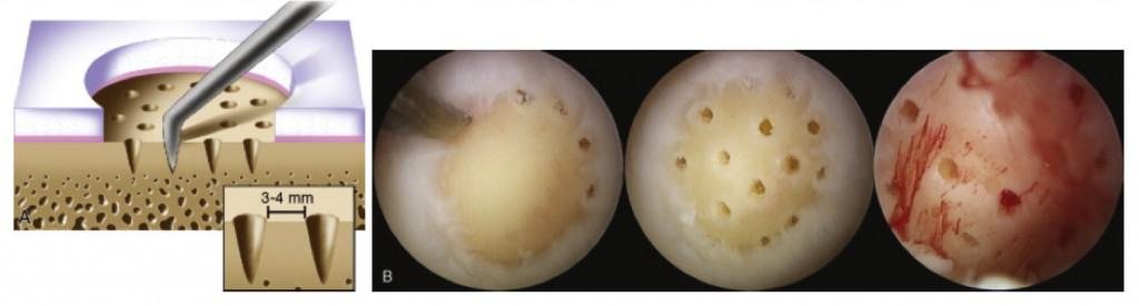 lesões osteocondrais, Condropatia e lesões osteocondrais, Ortopedista Especialista em Lesões da Cartilagem - DF